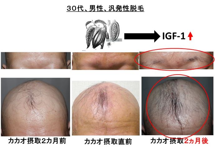 円形脱毛症　病院